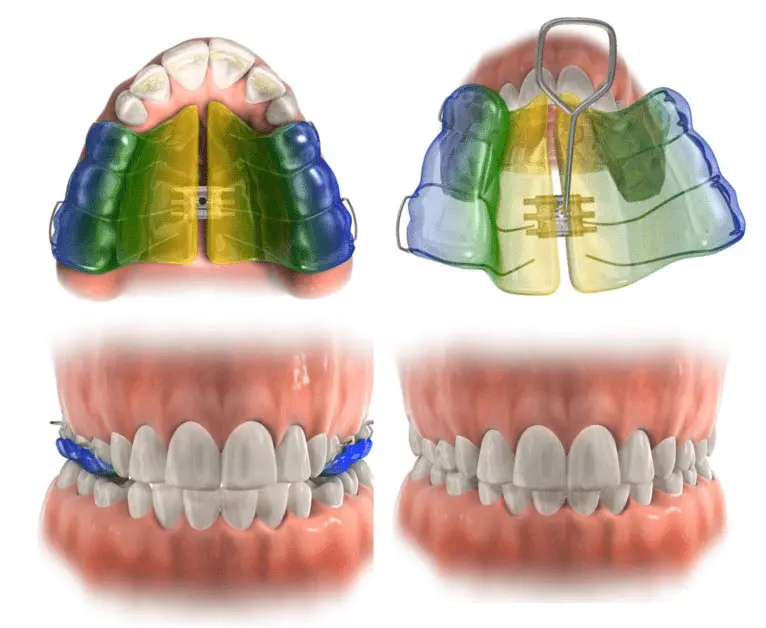 A removable expander can be used to widen the upper arch as illustrated here.
