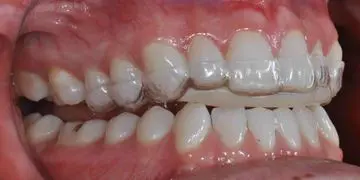 Close-up of a person's teeth with a transparent dental retainer on the upper row.