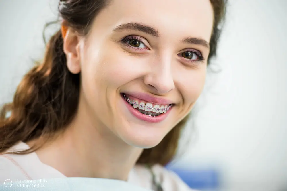 a woman smiling with braces. Clear Braces vs Metal Braces in Austin, TX