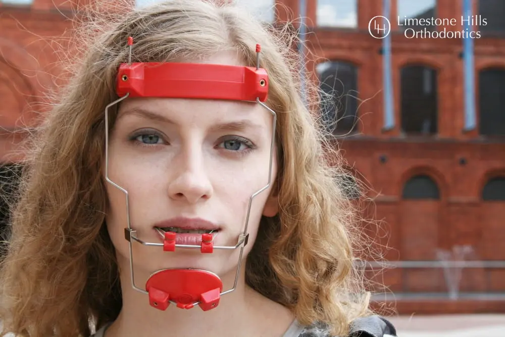 A woman smiling with red Reverse-Pull Headgear orthodontic appliances on her face in Austin, TX.