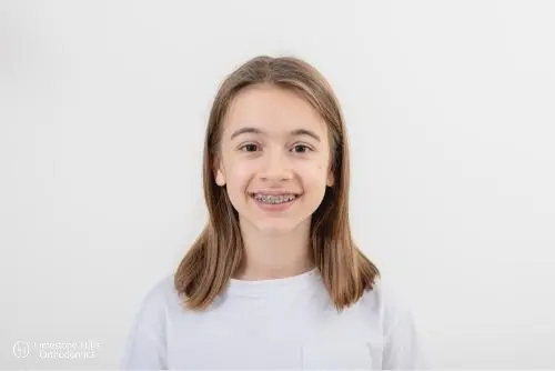 a girl smiling at the camera Braces for Overbite