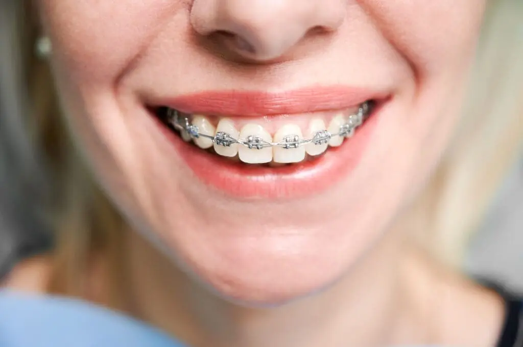 smiling young woman with braces teeth - Overbite vs Underbite: Causes, Appearance, and When Each Matters