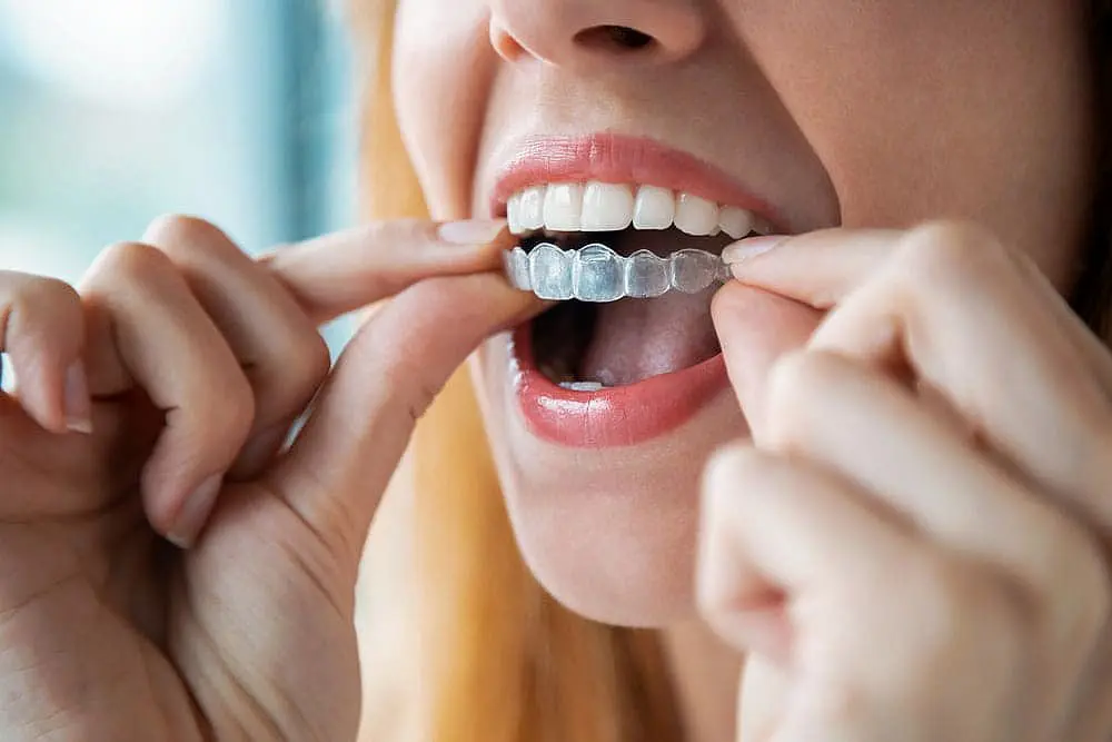 A close-up shows hands inserting a clear aligner onto a person's teeth. Limestone Hills Orthodontics in Austin, TX, offers clear aligner treatments.
