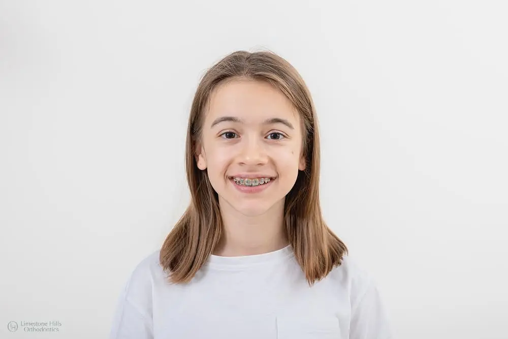 brunette caucasian girl smiling metal braces her teeth after asking about When to See an Orthodontist for Kids