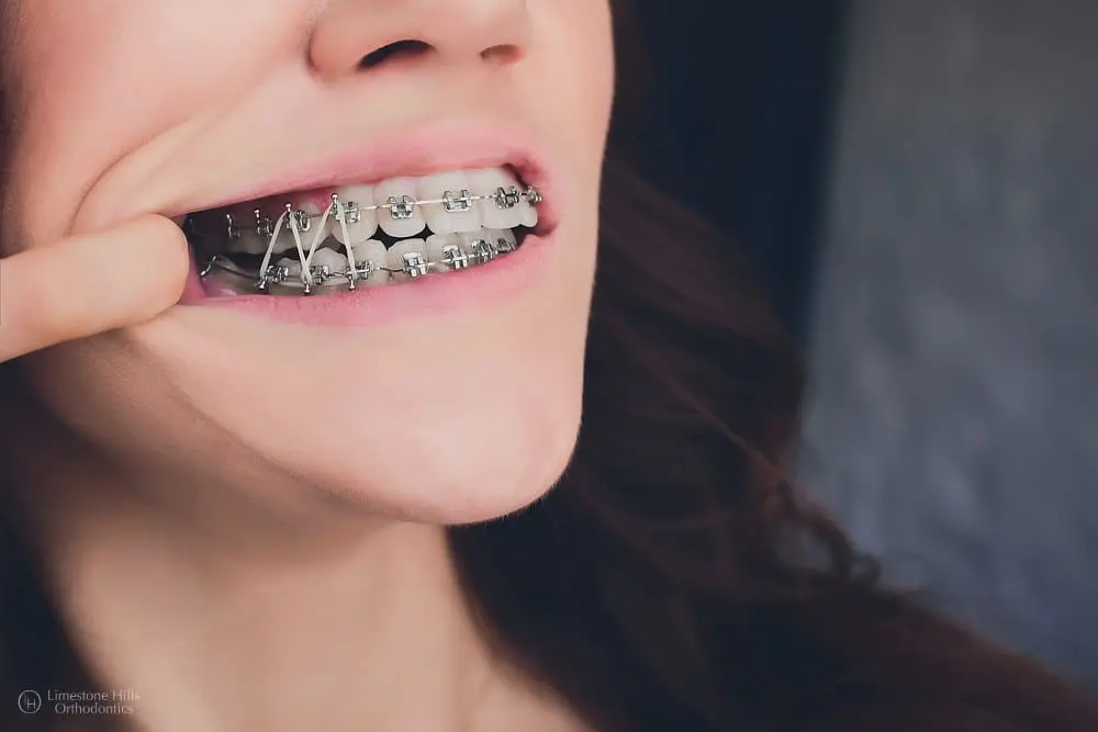 Close-up of a woman wearing orthodontic rubber bands on her braces.