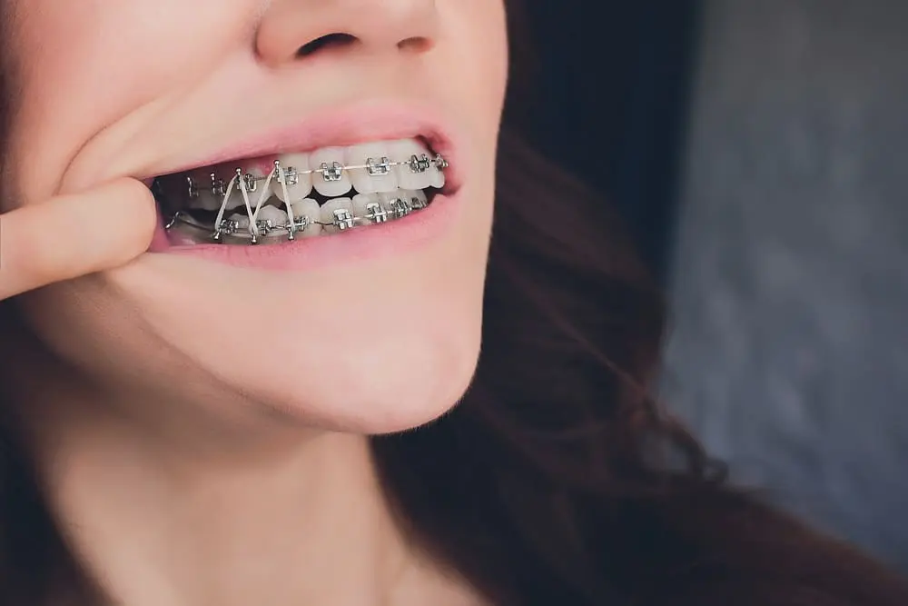 Close-up of a woman wearing orthodontic rubber bands on her braces.