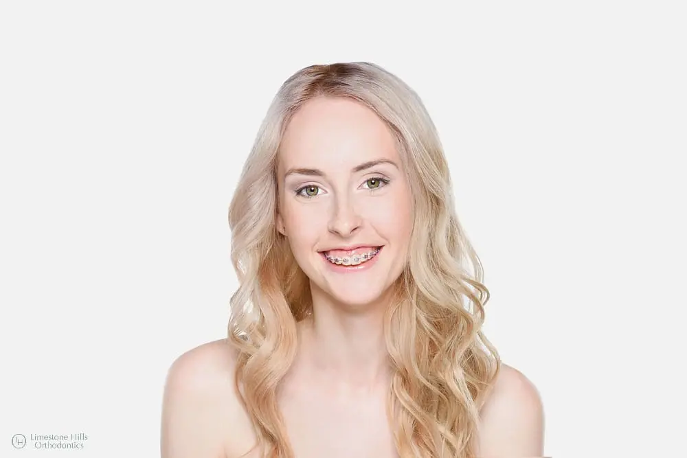Blonde woman with metal braces smiling cheerfully after getting braces a second time