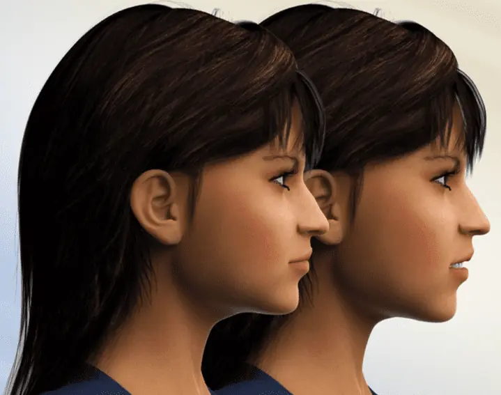 Lateral view before and after maxillary impaction jaw surgery for Treatment of Gummy Smile and Overbite at Limestone Hills Orthodontics in Austin, TX. Lateral view before and after maxillary impaction jaw surgery for Treatment of Gummy Smile and Overbite at Limestone Hills Orthodontics in Austin, TX.