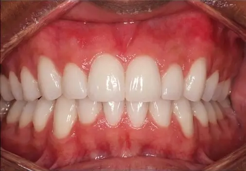 A patient at Limestone Hills Orthodontics in Austin, TX shows straight, white teeth and healthy gums after overbite correction.