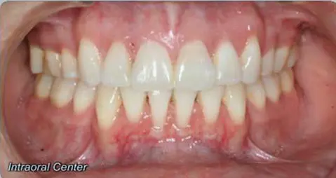 Person’s mouth close-up after Adult Open Bite and Crowding treatment at Limestone Hills Orthodontics in Austin, TX; "Intraoral Center" text at lower left.