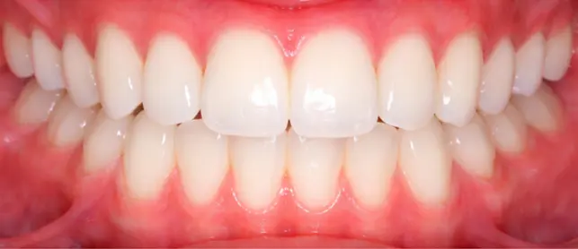 At Limestone Hills Orthodontics in Austin, TX, a close-up of a mouth shows clean, white teeth and healthy gums after treatment.