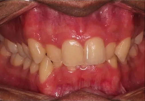 Crowded, misaligned teeth with visible gums shown before treatment at Limestone Hills Orthodontics in Austin, TX.