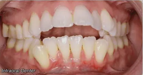 At Limestone Hills Orthodontics in Austin, TX, close-up of adult open bite and crowding with misaligned teeth and minor gum redness.