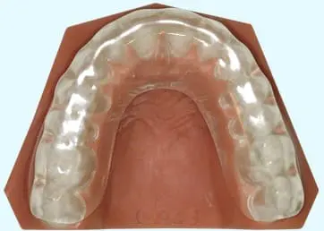 TMJ mouth guard for jaw pain relief and protection at Limestone Hills Orthodontics in Austin, TX.