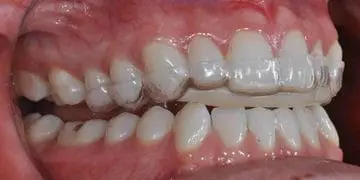 Custom TMJ night guard designed to protect teeth and reduce jaw discomfort at Limestone Hills Orthodontics in Austin, TX.