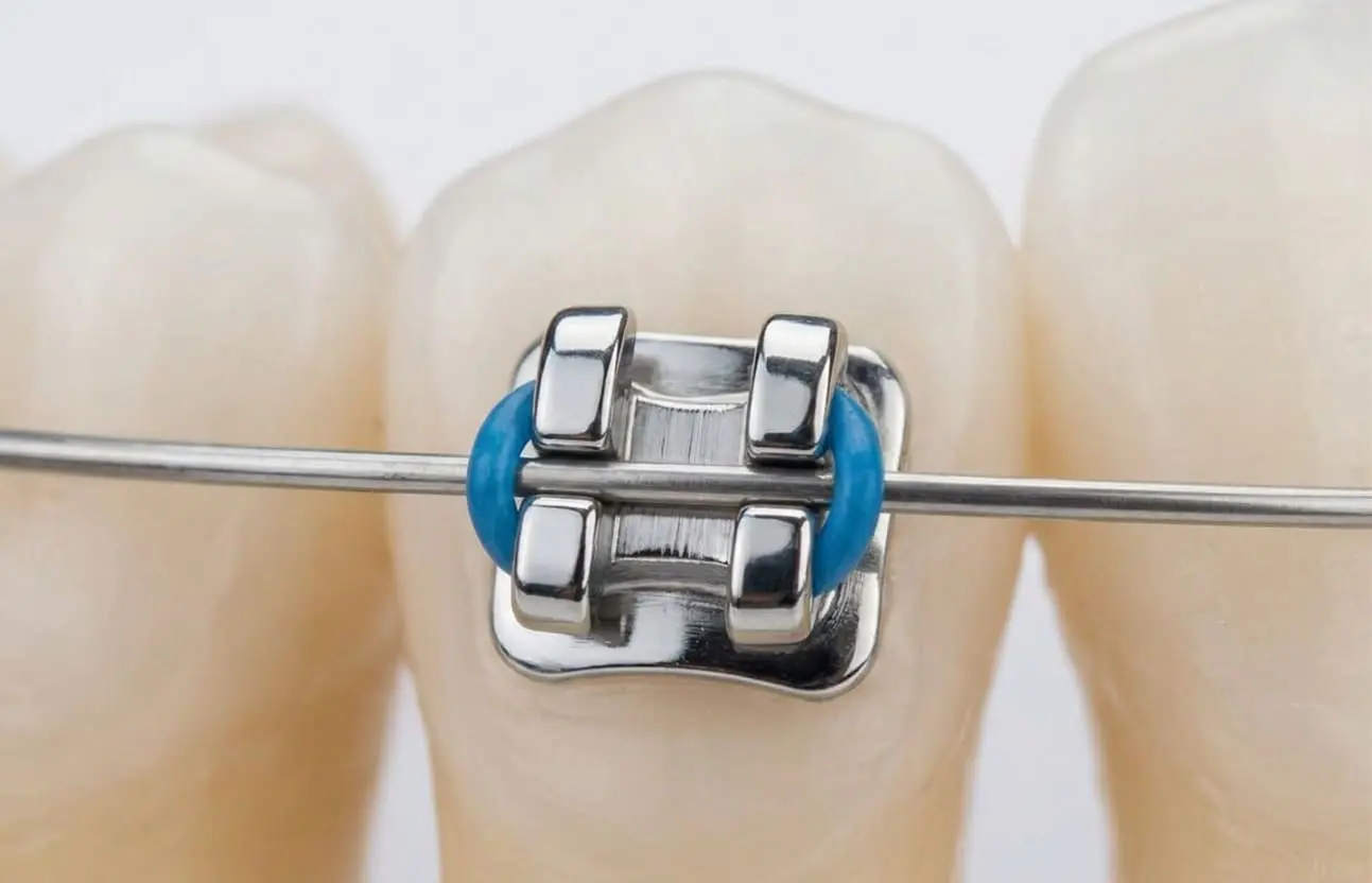 Dental braces with stainless steel brackets and blue elastic at Limestone Hills Orthodontics in Austin, TX on artificial teeth.