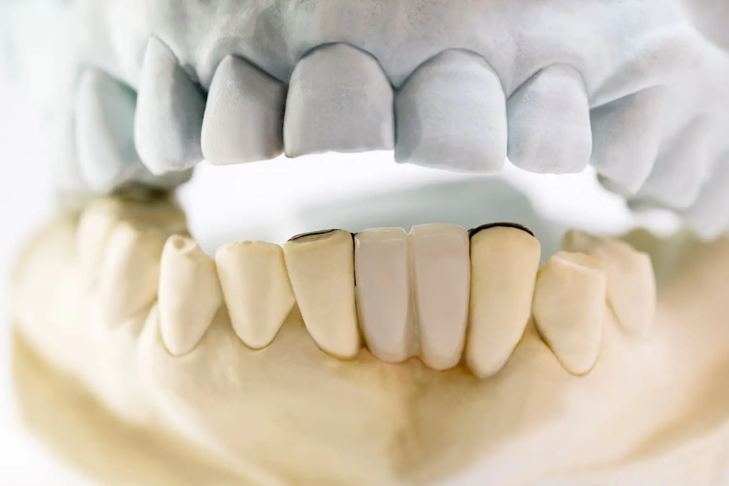 Orthodontic dental models showing custom TMJ splints for teeth grinding protection at Limestone Hills Orthodontics in Austin, TX