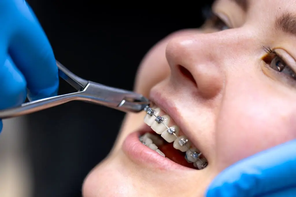 dental procedure installing braces close up dentistry braces teeth - Open Bite Treatment: Causes, Types, and How Orthodontics Can Help | Limestone Hills Orthodontics Austin TX