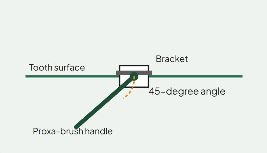 Diagram illustrating a 45-degree angle for using a proxa-brush on a tooth bracket - How to Clean Braces: Daily Routine, Tools, and Technique Limestone Hills Orthodontics Austin TX 