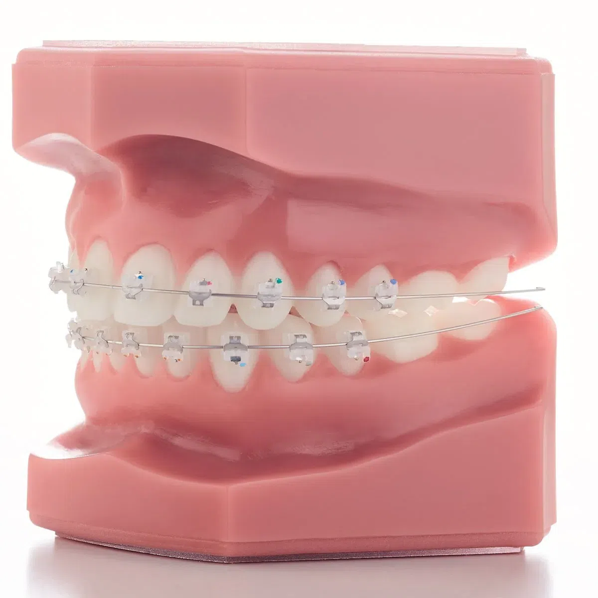 A model of teeth with traditional metal braces is shown. Limestone Hills Orthodontics, located in Austin, TX, provides various orthodontic treatments.