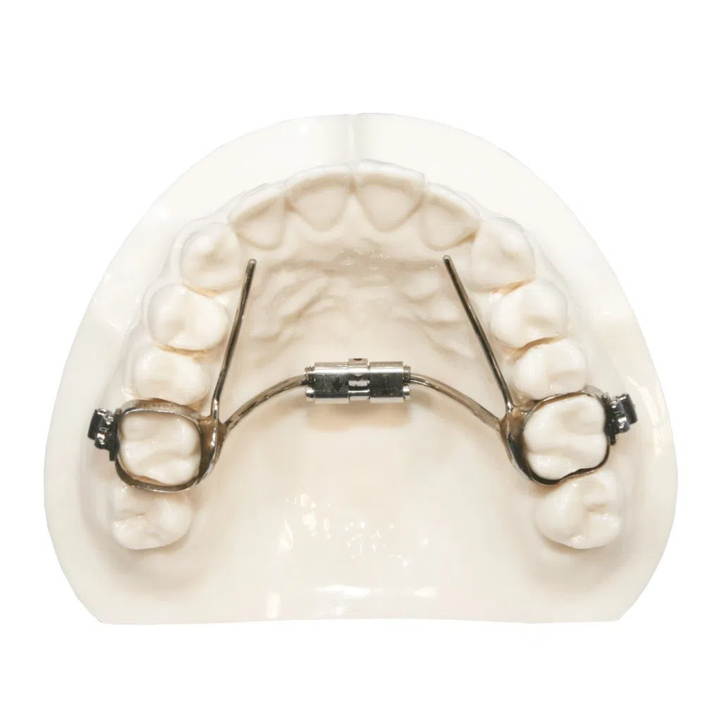 A dental model shows a mini rapid palatal expander appliance fitted to the upper teeth. Limestone Hills Orthodontics in Austin, TX, may use these devices.
