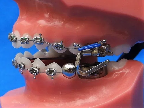 A dental model shows braces with a Forsus appliance connecting the upper and lower arches. Limestone Hills Orthodontics in Austin, TX, may use Forsus for bite correction.