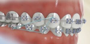 Diagram of rubber bands delivering forces to the teeth
