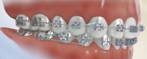 Limestone Hills Orthodontics
