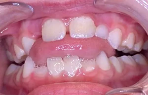 A close-up shows a child's open bite malocclusion, where upper and lower front teeth don't meet. Limestone Hills Orthodontics in Austin, TX, can assess and treat this.