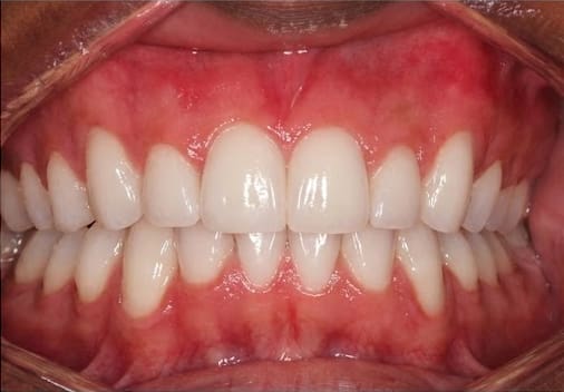 After braces treatment with bite-pads showing corrected overbite alignment