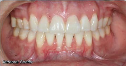 After braces, extractions, and myofunctional therapy showing a corrected open bite with aligned teeth