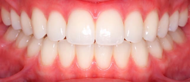 After Invisalign treatment showing improved tooth alignment