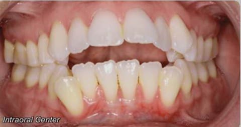 Before braces and myofunctional therapy showing an open bite with misaligned teeth