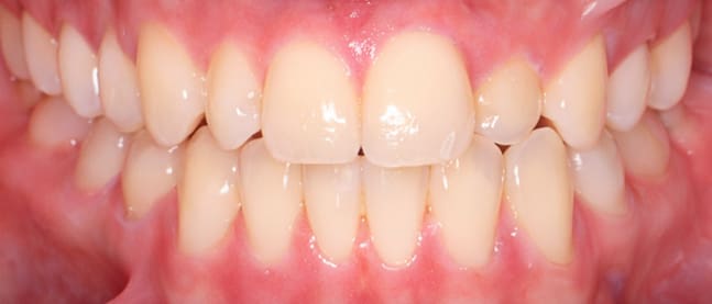 Before Invisalign treatment showing crowded teeth
